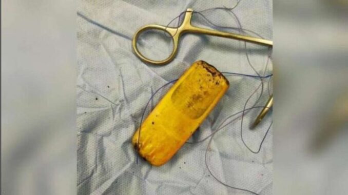 Un hombre vivió con un celular en el estómago durante seis meses